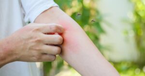 Alergia a picadas de mosquito: causas e tratamentos